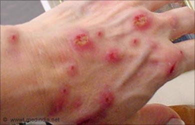 disease