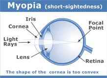 myopic eyes