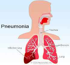 pneumonia