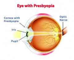 presbyopia eyes