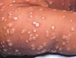 smallpox