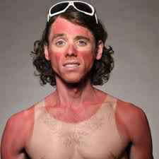 sunburned